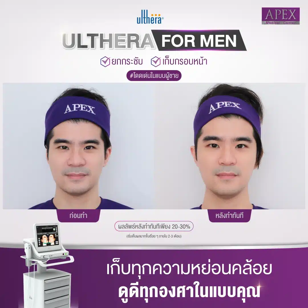 Looks charm to look even better. Clear front frame, clear Jawline, look perfect at any angle. With a specific technique for lifting and tightening Ultherapy for men [2]
