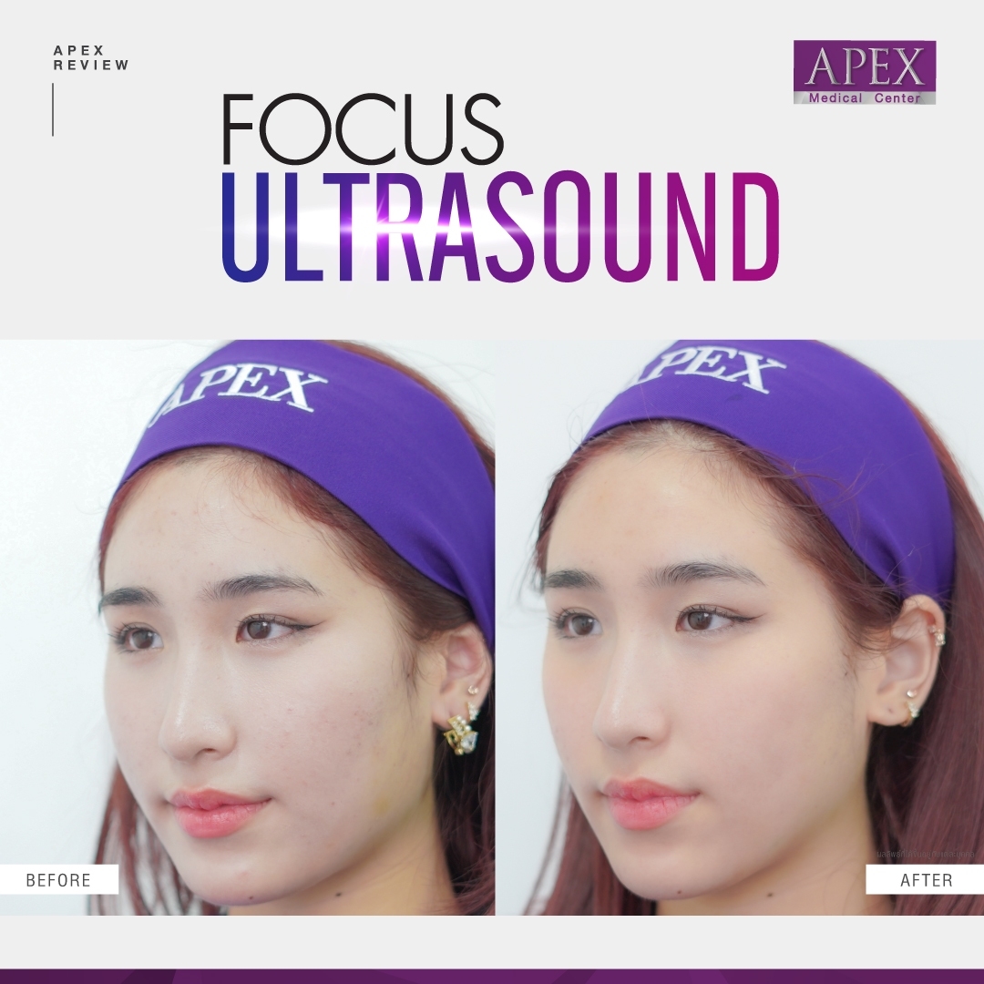 Apex , apexmedicalcenter , เอเพ็กซ์, เอเพ็กเมดิคอลเซ็นเตอร์ ,เสริมความงาม , คลินิกเสริมความงาม , Focus Ultrasound , Focus Ultrasound ราคาเท่าไหร่ , Focus Ultrasound ที่ไหนดี , Focus Ultrasound ราคา , Focus Ultrasound คืออะไร , Focus Ultrasound รีวิว , Focus Ultrasound เหมาะกับใคร , Focus Ultrasound Apex , Focus Ultrasound pantip , เครื่อง Focus Ultrasound , Focus Ultrasound ราคาเท่าไหร่ , Focus Ultrasound2023 , Focus Ultrasound2023 , ยกกระชับผิว, ยกกระชับ , ยกกระชับหน้า , Hifu , ultraformer mpt , หน้าเรียว , กรอบหน้าชัด