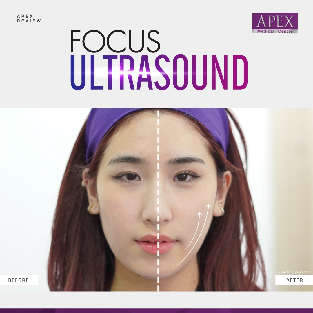 Apex , apexmedicalcenter , เอเพ็กซ์ , เอเพ็กเมดิคอลเซ็นเตอร์ , เสริมความงาม , คลินิกเสริมความงาม , Focus Ultrasound , Focus Ultrasound ราคาเท่าไหร่, Focus Ultrasound ที่ไหนดี , Focus Ultrasound ราคา , Focus Ultrasound คืออะไร , Focus Ultrasound รีวิว , Focus Ultrasound เหมาะกับใคร , Focus Ultrasound Apex , Focus Ultrasound pantip , เครื่อง Focus Ultrasound , Focus Ultrasound ราคาเท่าไหร่, Focus Ultrasound2023 , Focus Ultrasound2023 , ยกกระชับผิว , ยกกระชับ , ยกกระชับหน้า , Hifu , ultraformer mpt , หน้าเรียว , กรอบหน้าชัด