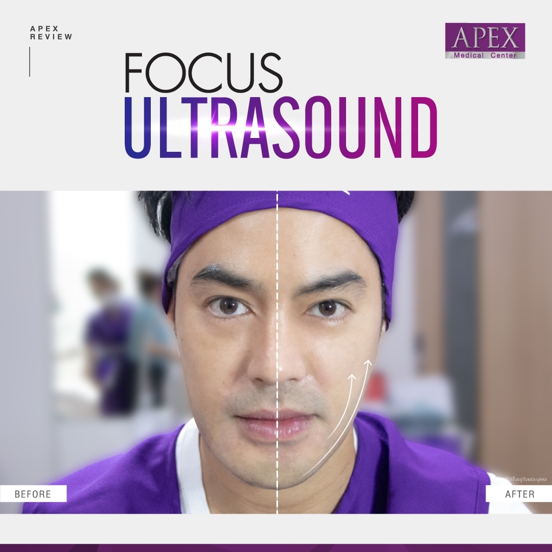 Apex , apexmedicalcenter , เอเพ็กซ์ , เอเพ็กเมดิคอลเซ็นเตอร์ , เสริมความงาม , คลินิกเสริมความงาม , Focus Ultrasound , Focus Ultrasound ราคาเท่าไหร่, Focus Ultrasound ที่ไหนดี , Focus Ultrasound ราคา , Focus Ultrasound คืออะไร , Focus Ultrasound รีวิว , Focus Ultrasound เหมาะกับใคร , Focus Ultrasound Apex , Focus Ultrasound pantip , เครื่อง Focus Ultrasound , Focus Ultrasound ราคาเท่าไหร่, Focus Ultrasound2023 , Focus Ultrasound2023 , ยกกระชับผิว , ยกกระชับ , ยกกระชับหน้า , Hifu , ultraformer mpt , หน้าเรียว , กรอบหน้าชัด