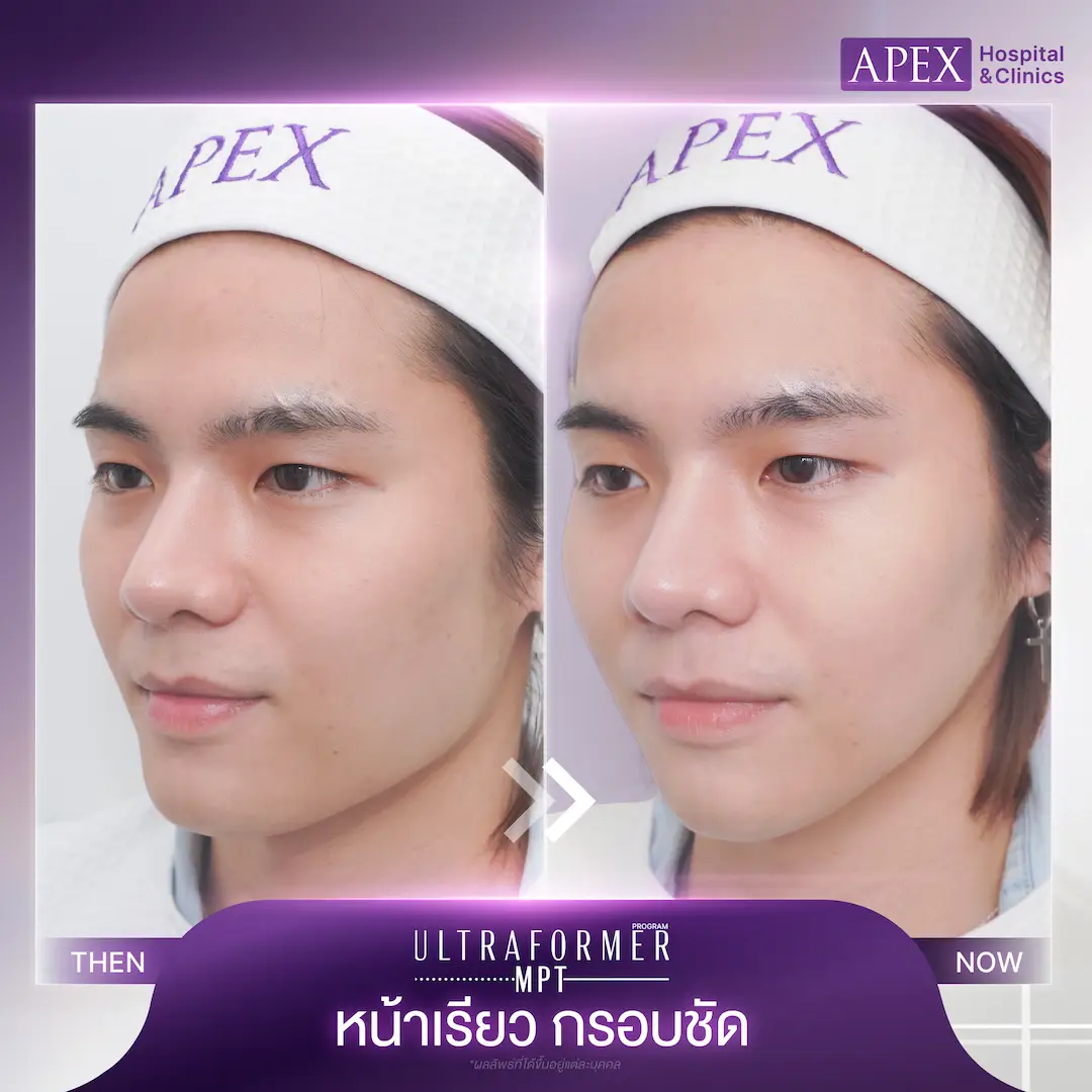 รีวิว Ultraformer MPT