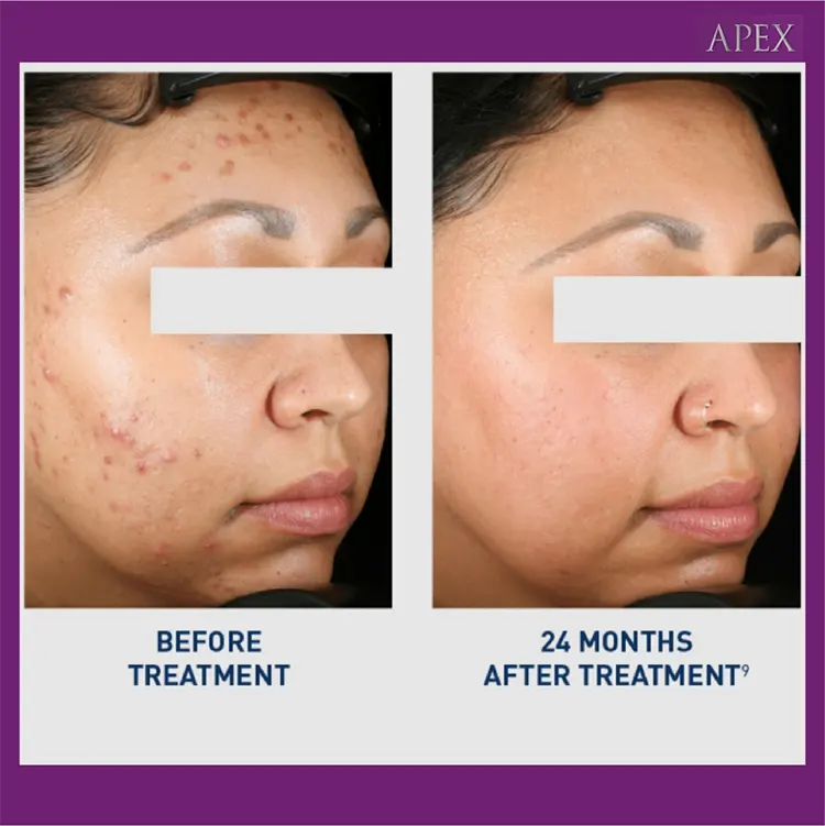 ก่อนและหลังทำ Accure Laser