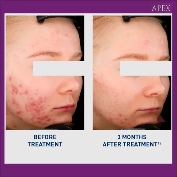 ก่อนและหลังทำ Accure Laser