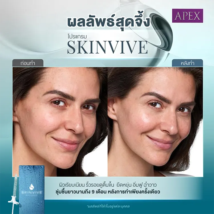 ก่อนและหลังฉีด Skinvive