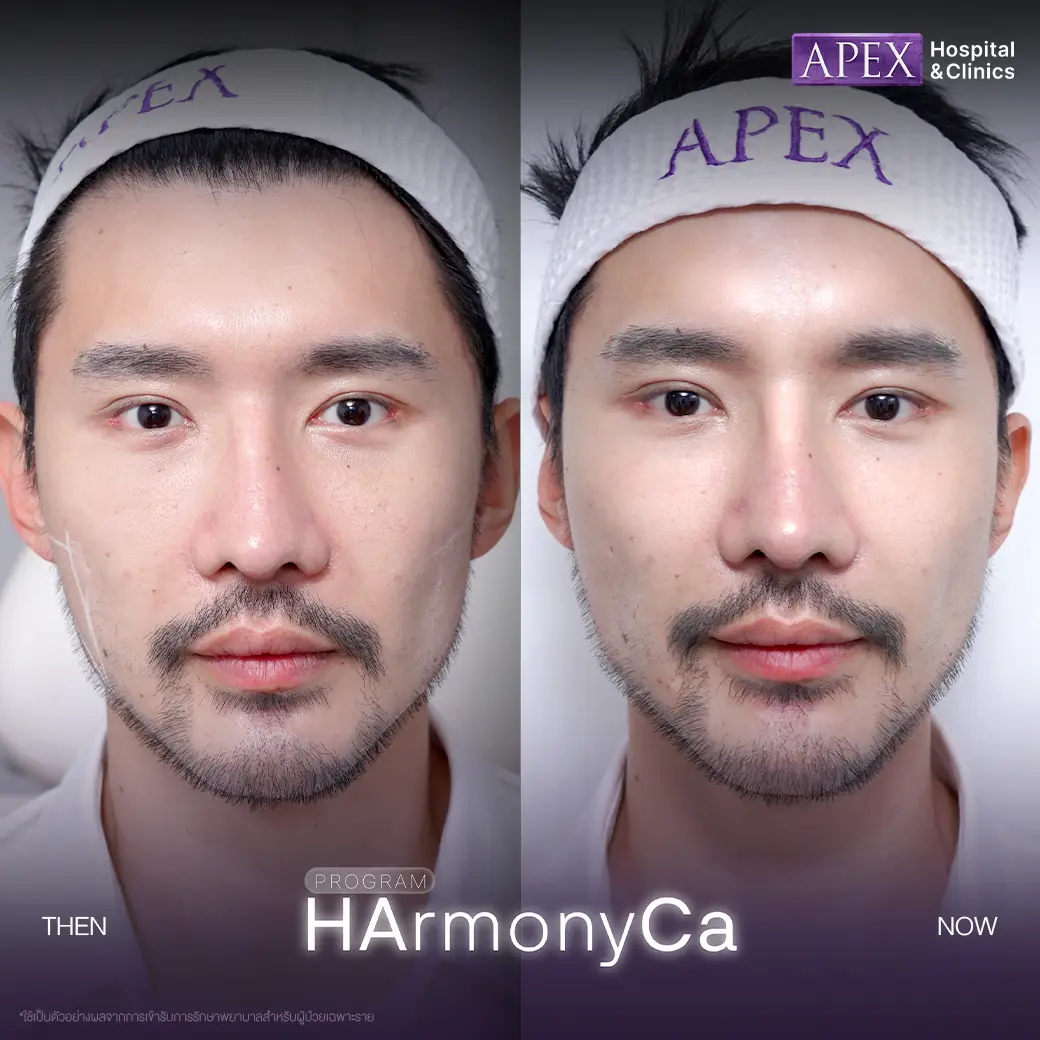 รีวิว HArmonyCa