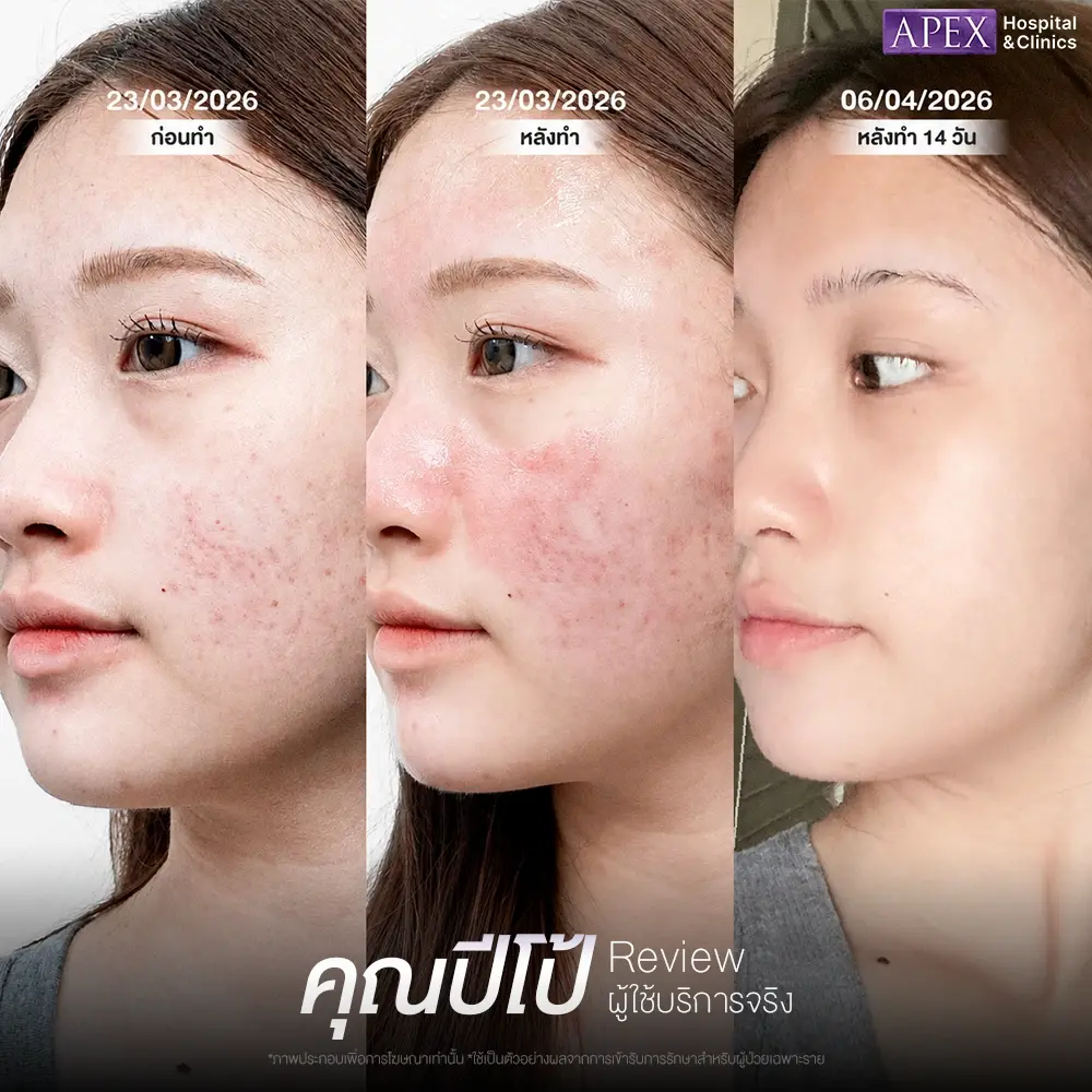 รีวิวหลังทำ Pico Laser