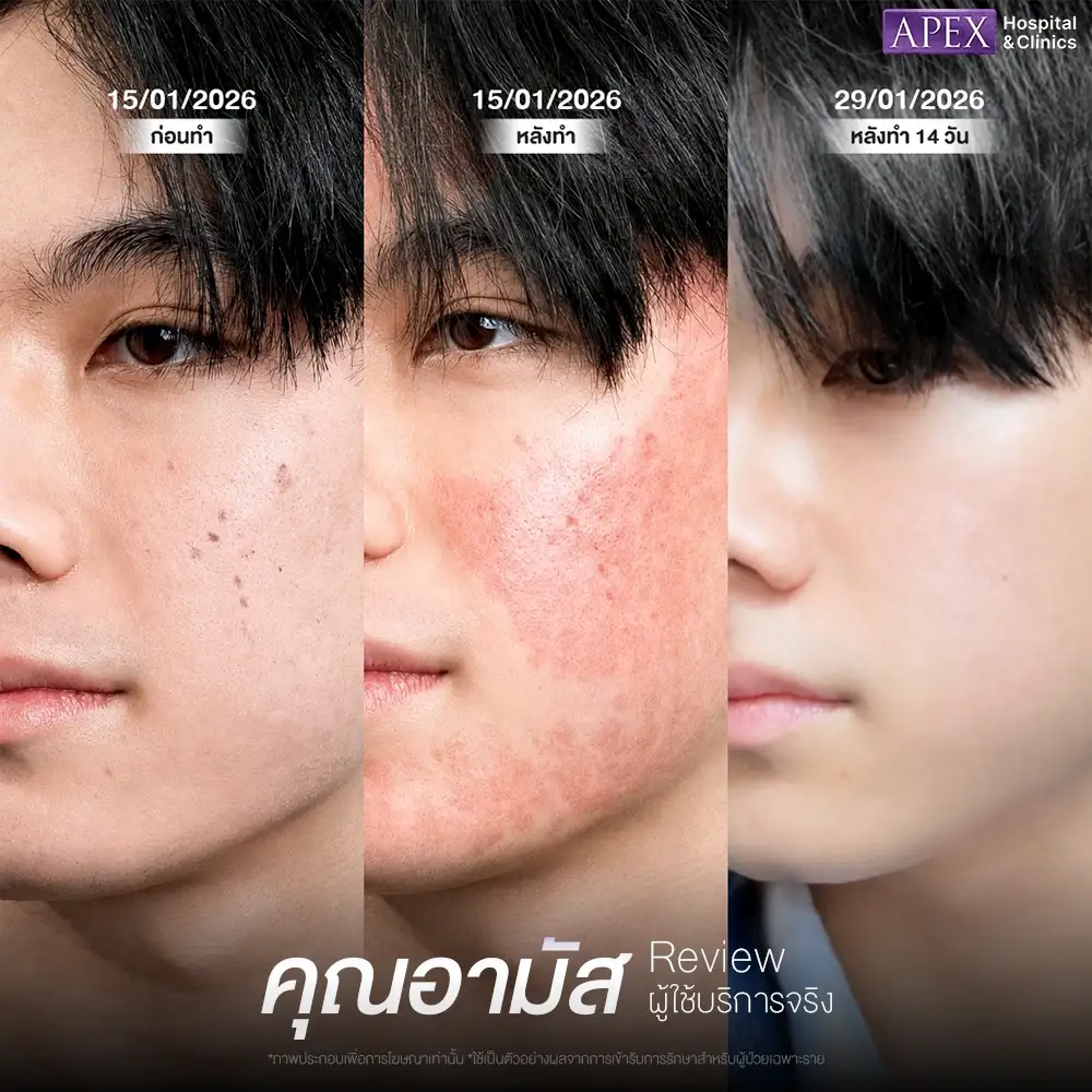 รีวิวหลังทำ Pico Laser