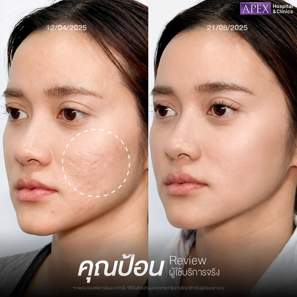 รีวิวหลังทำ Pico Laser