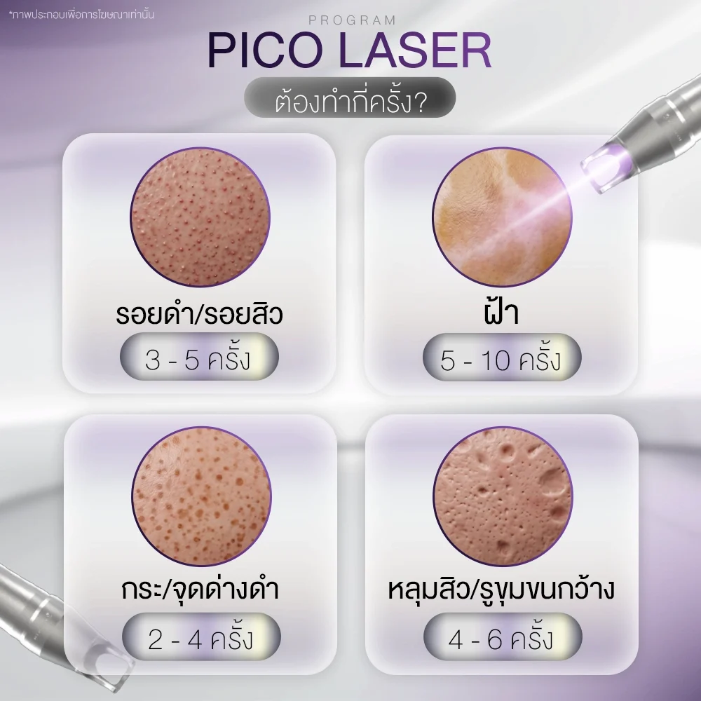 Pico Laser ควรทำกี่ครั้งถึงจะเห็นผล