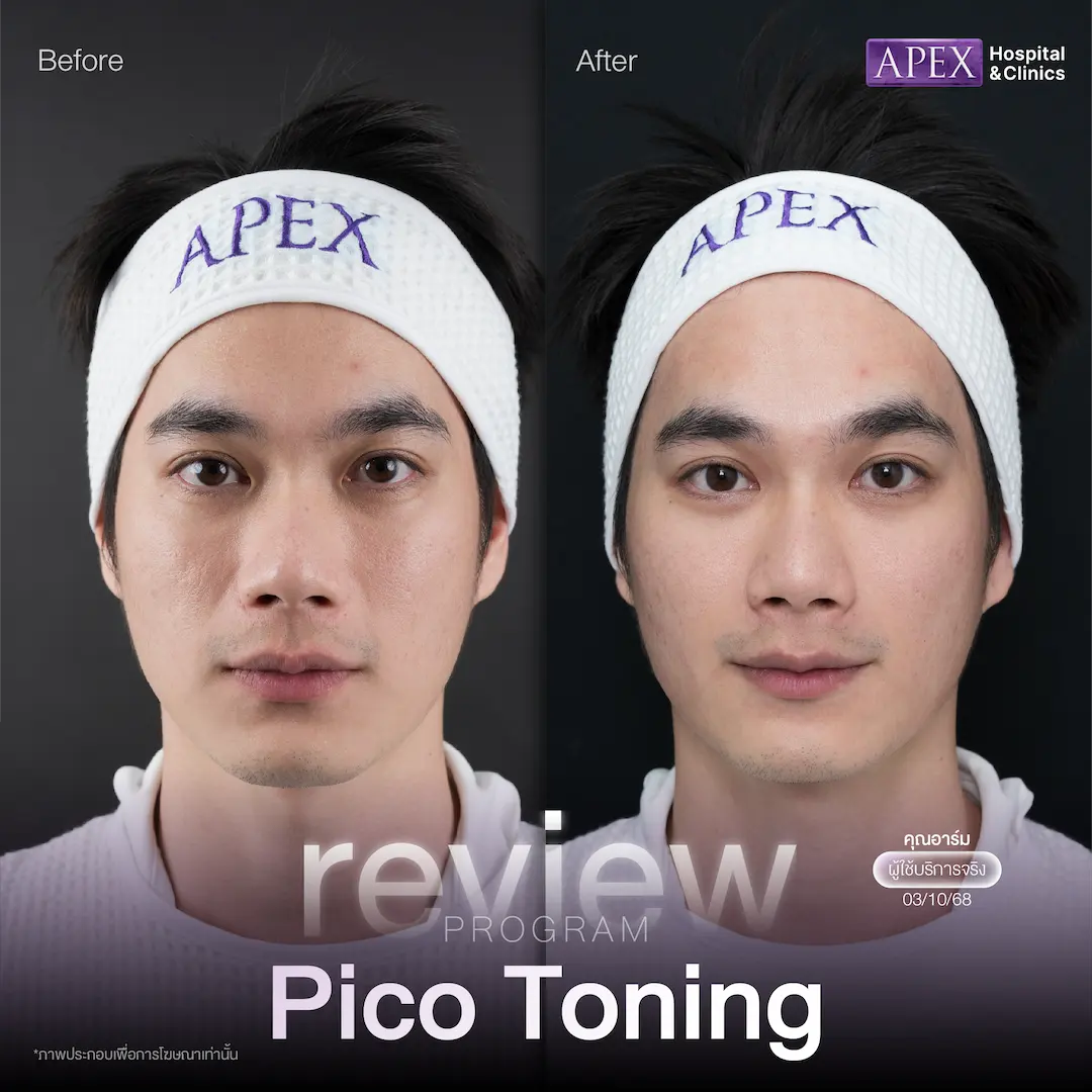Pico Toning รีวิว