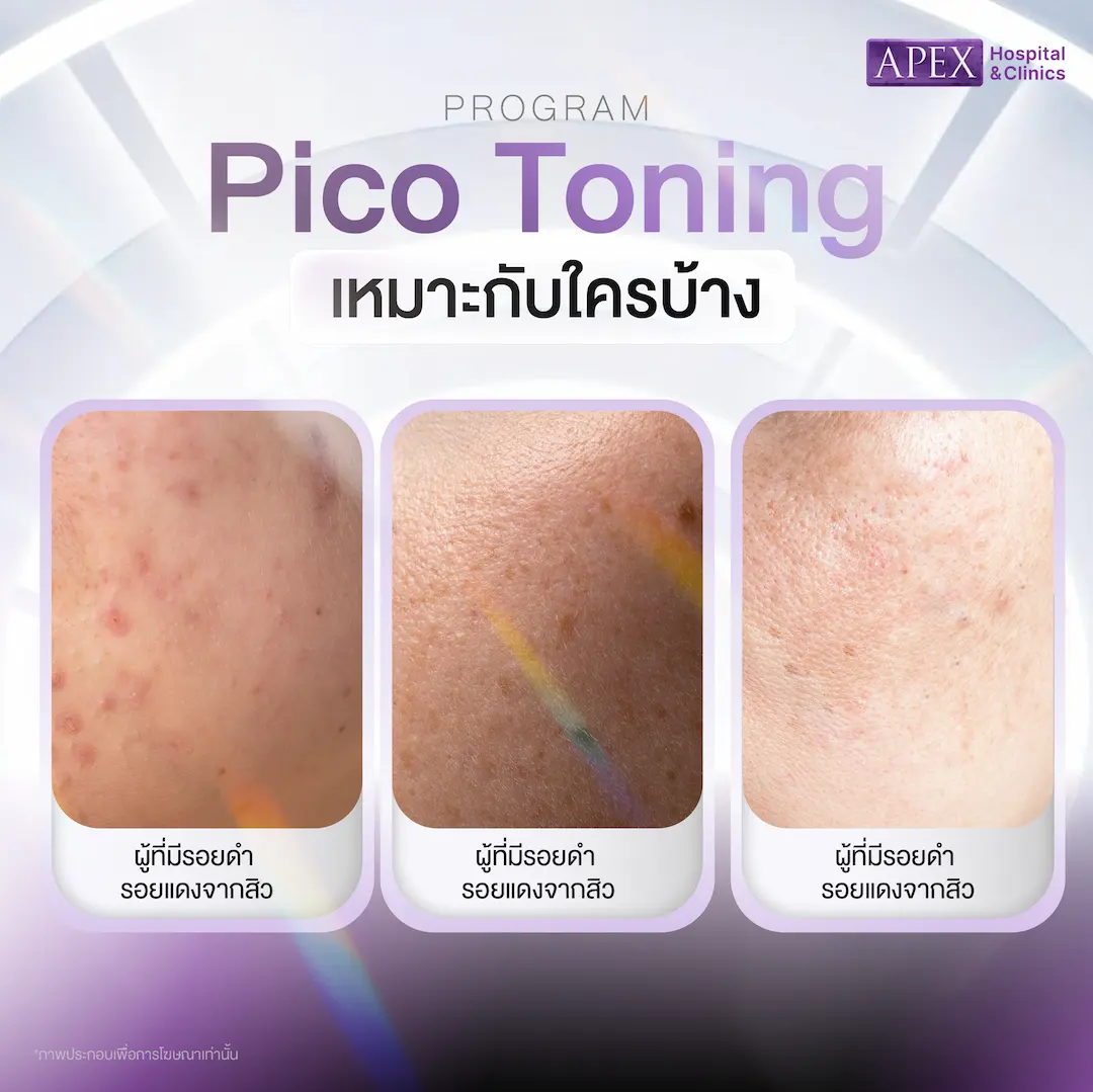 Pico Toning เหมาะกับใคร