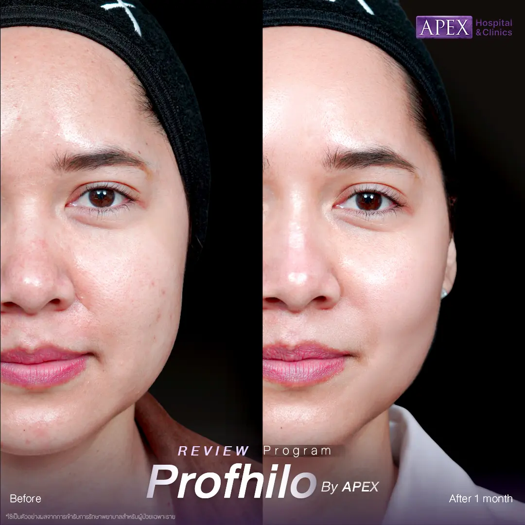รีวิว Profhilo