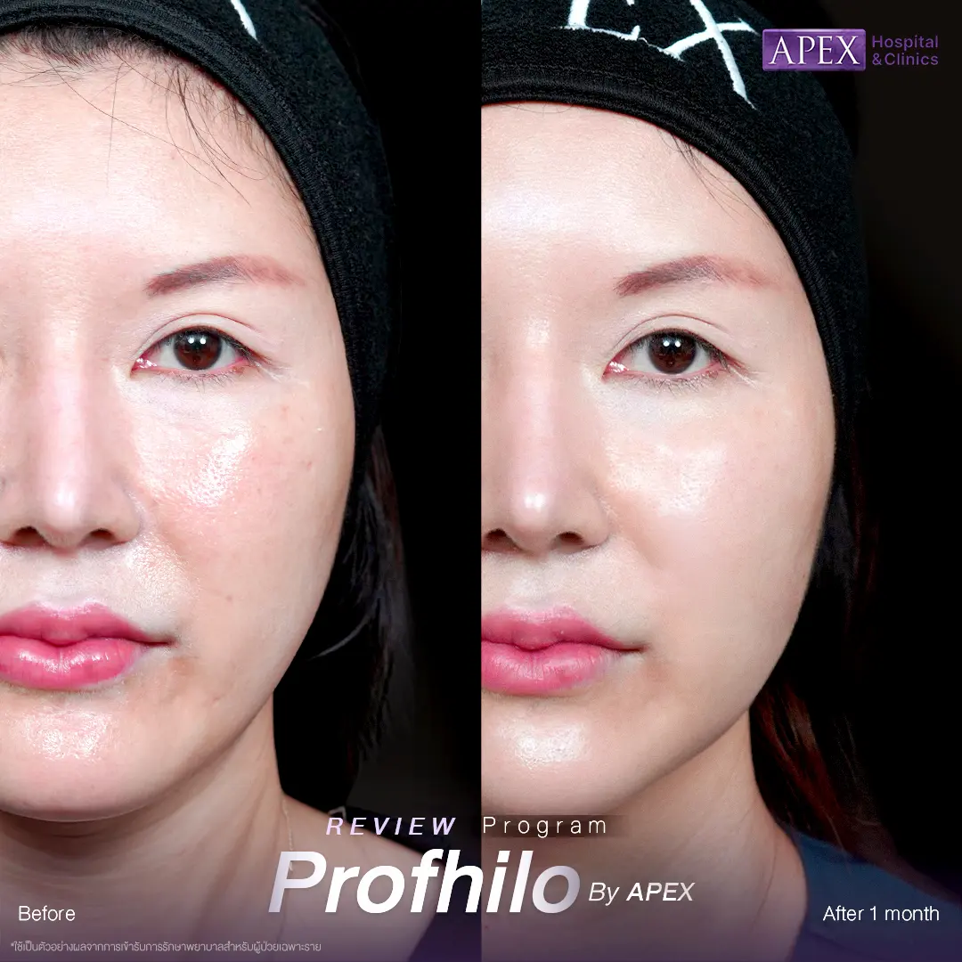 รีวิว Profhilo