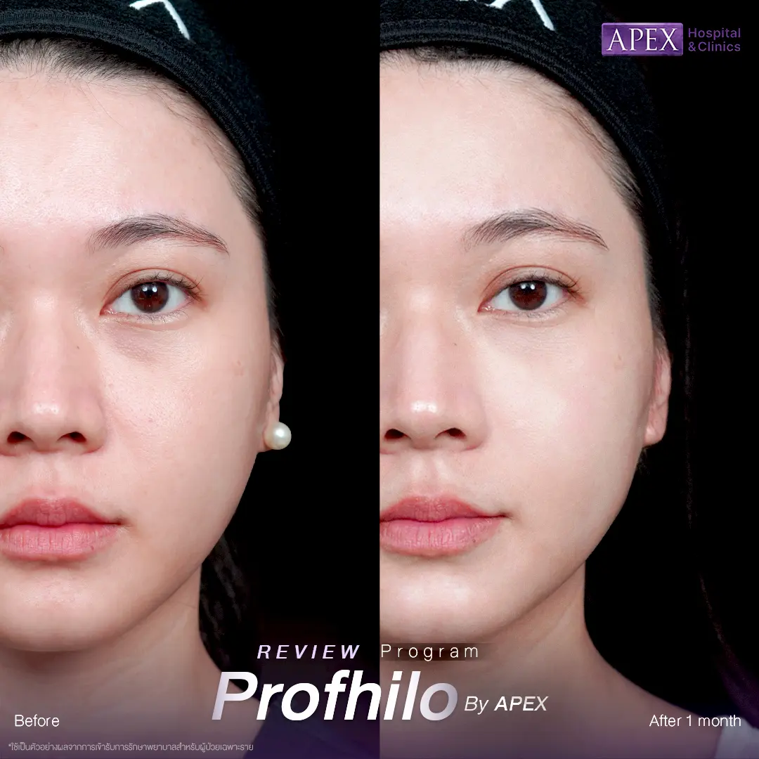 รีวิว Profhilo