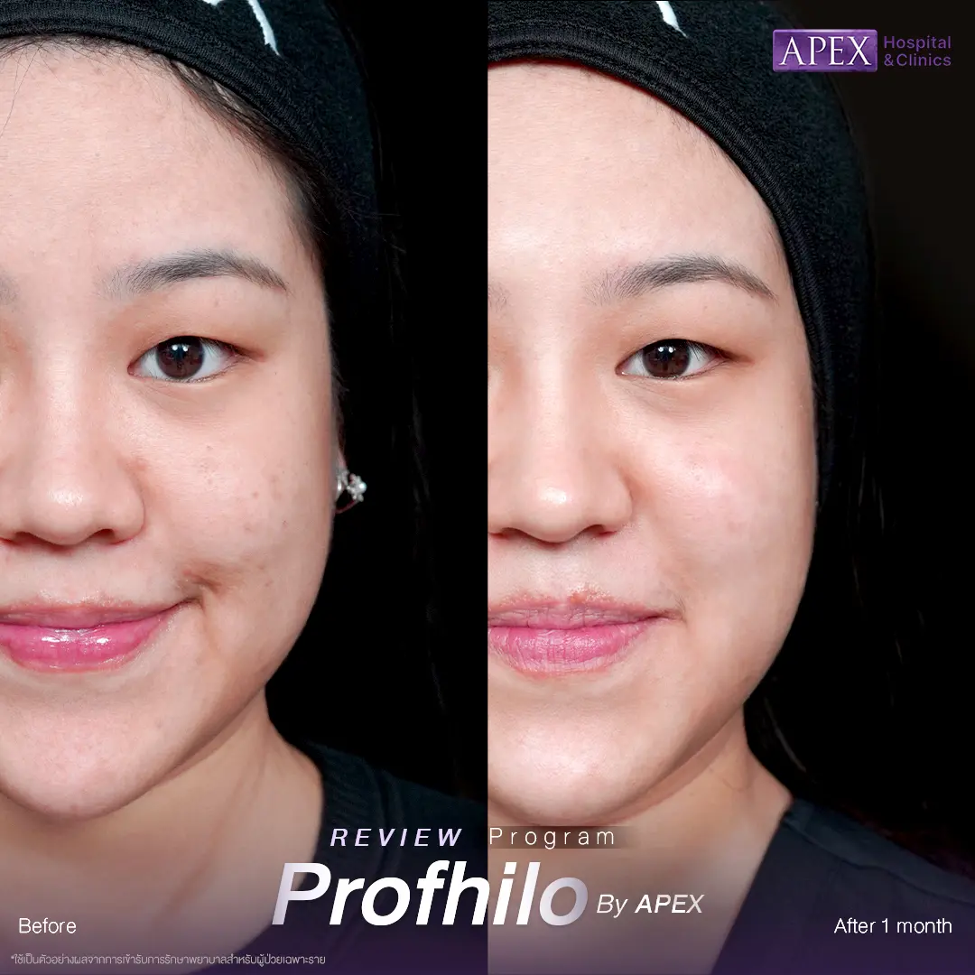 รีวิว Profhilo