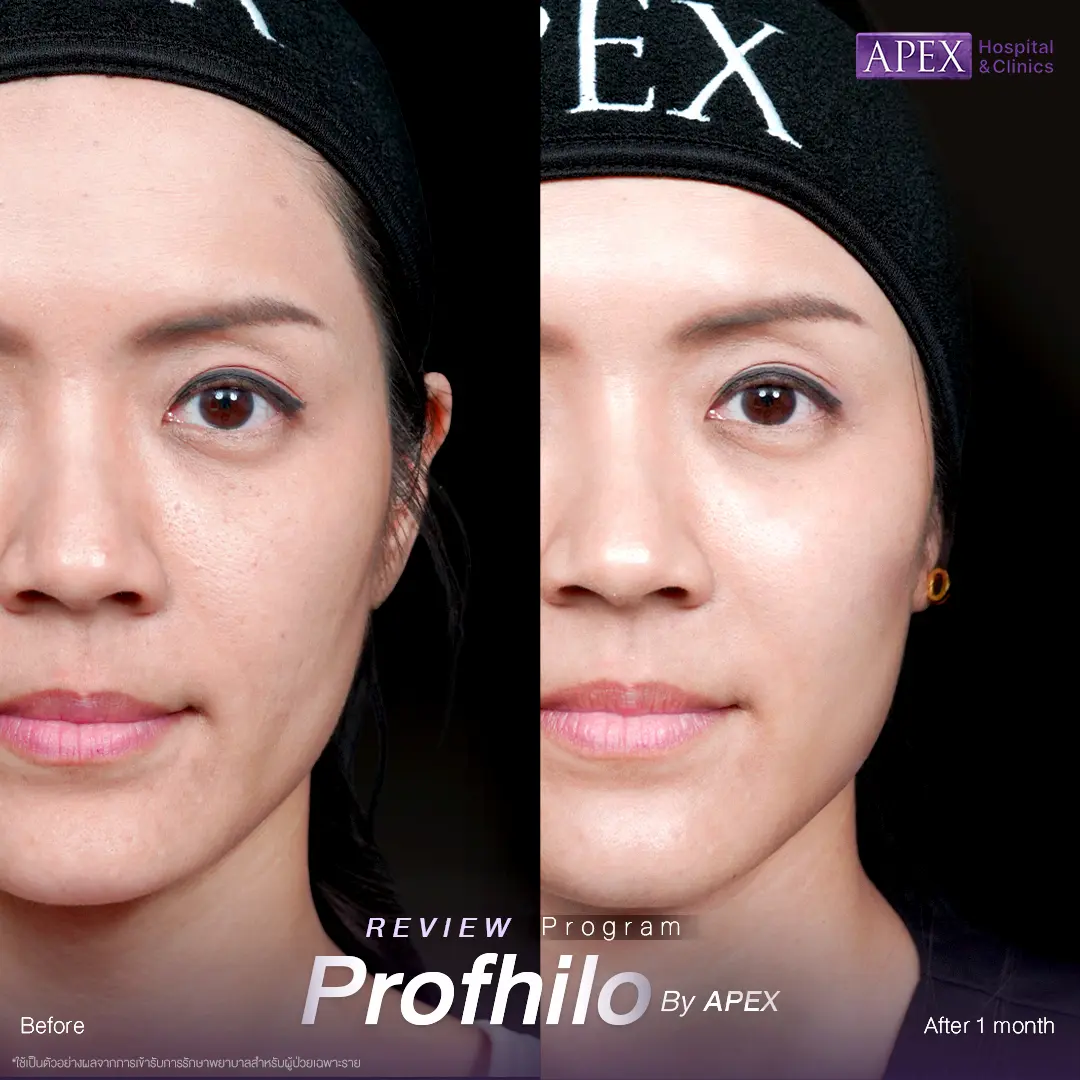 รีวิว Profhilo