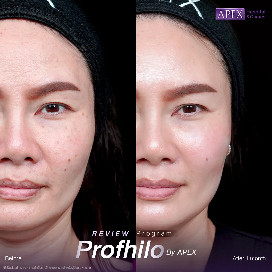 รีวิว Profhilo