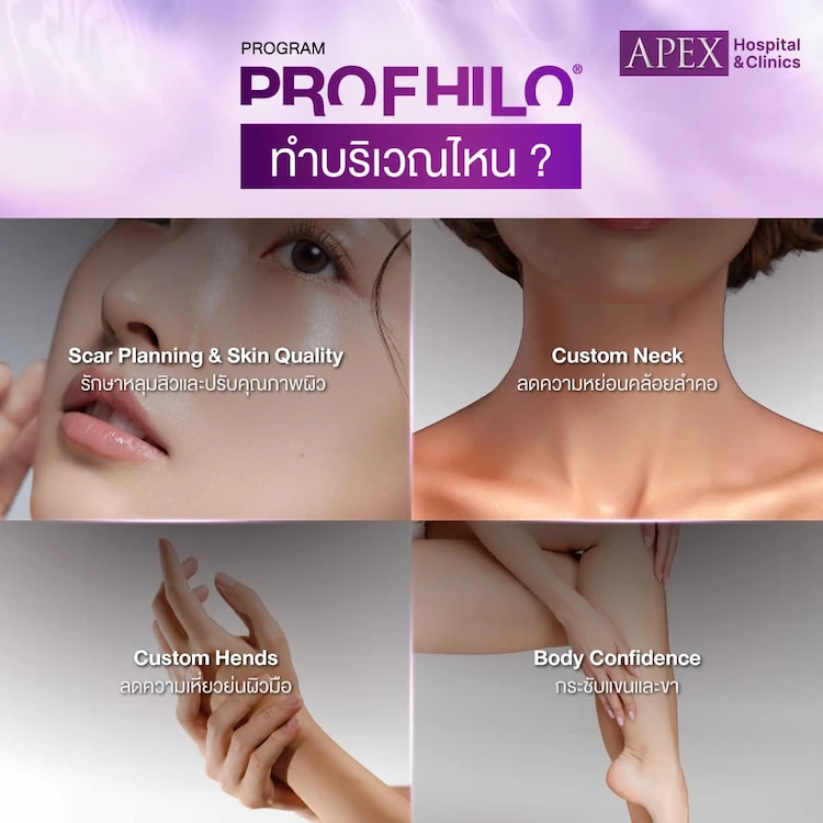 Profhilo ฉีดตรงไหน