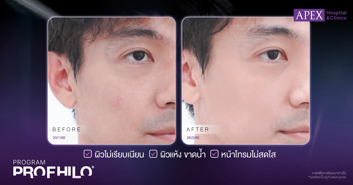 Profhilo รีวิว