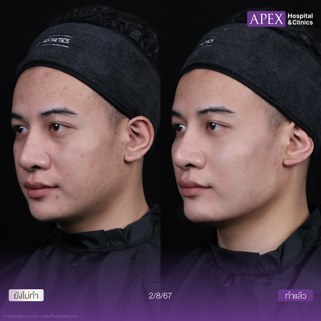 รีวิว Radiesse