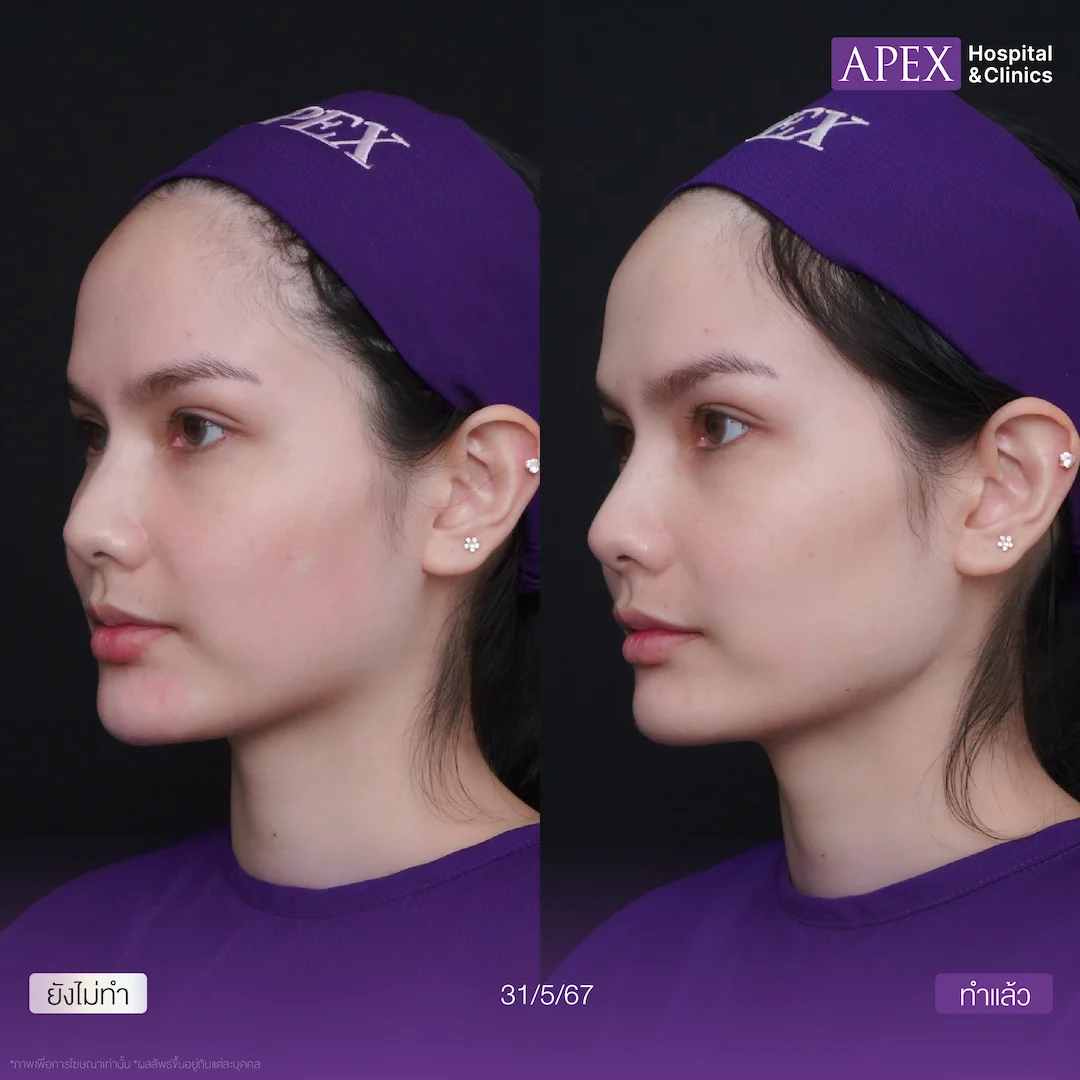 รีวิว Radiesse