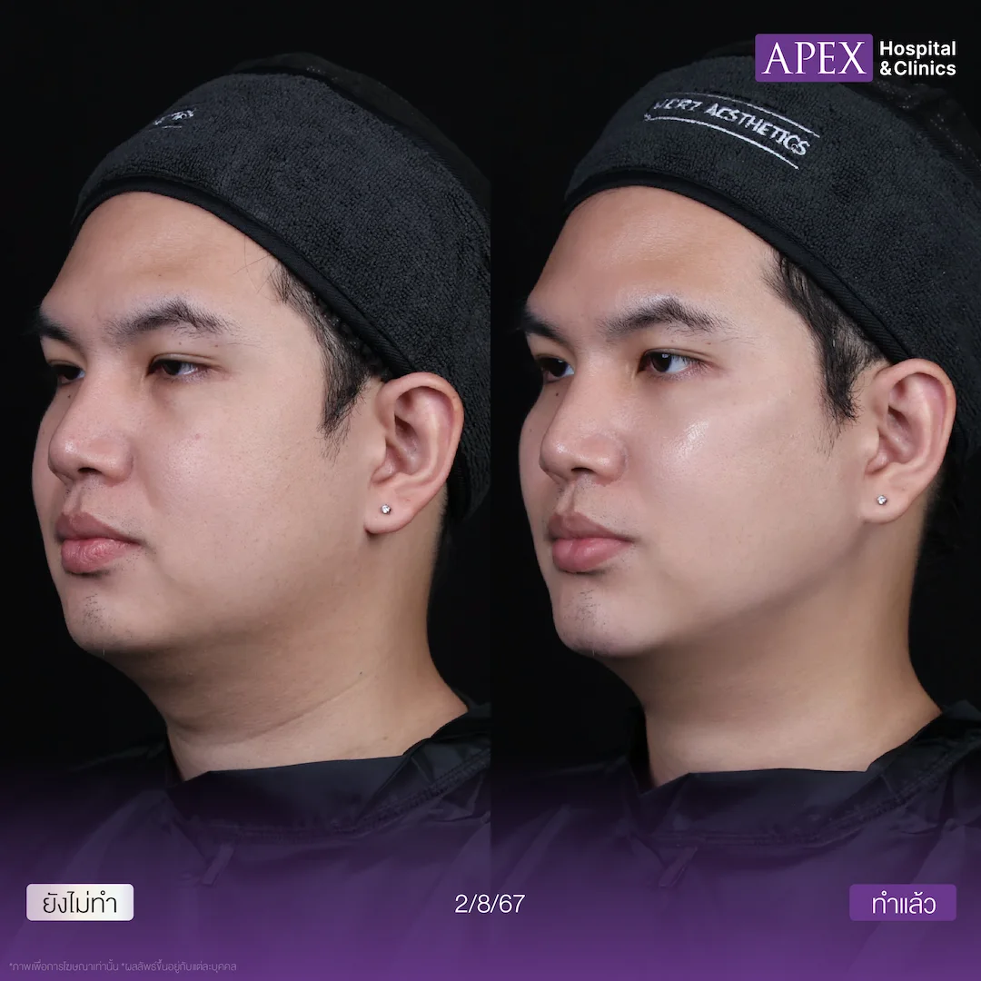 รีวิว Radiesse