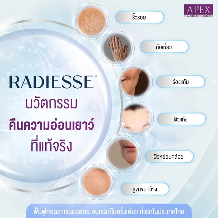 Radiesse ฉีดตำแหน่งไหนได้บ้าง
