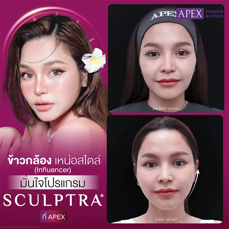 รีวิว Sculptra