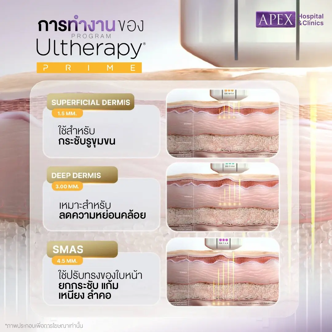 Ulthera Prime ลงถึงชั้นผิวไหนได้บ้าง