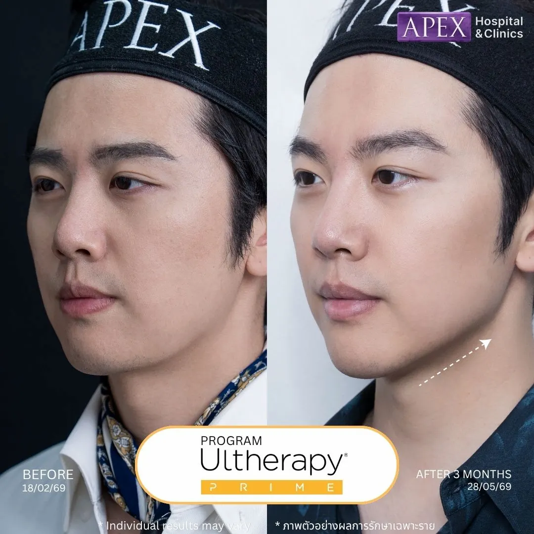 รีวิว Ulthera