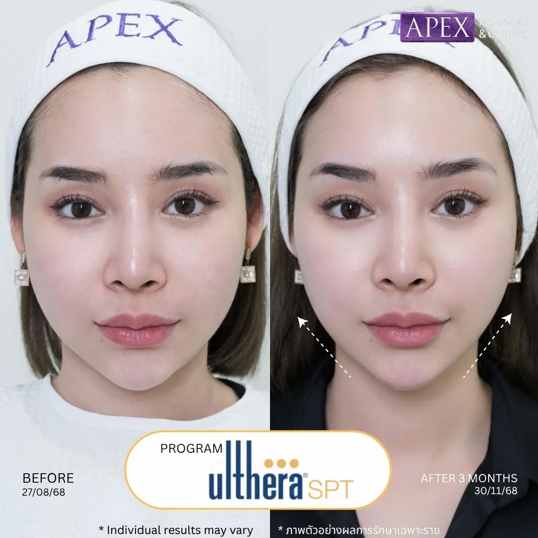 รีวิว Ulthera