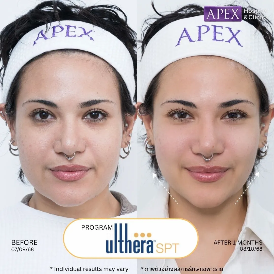 รีวิว Ulthera