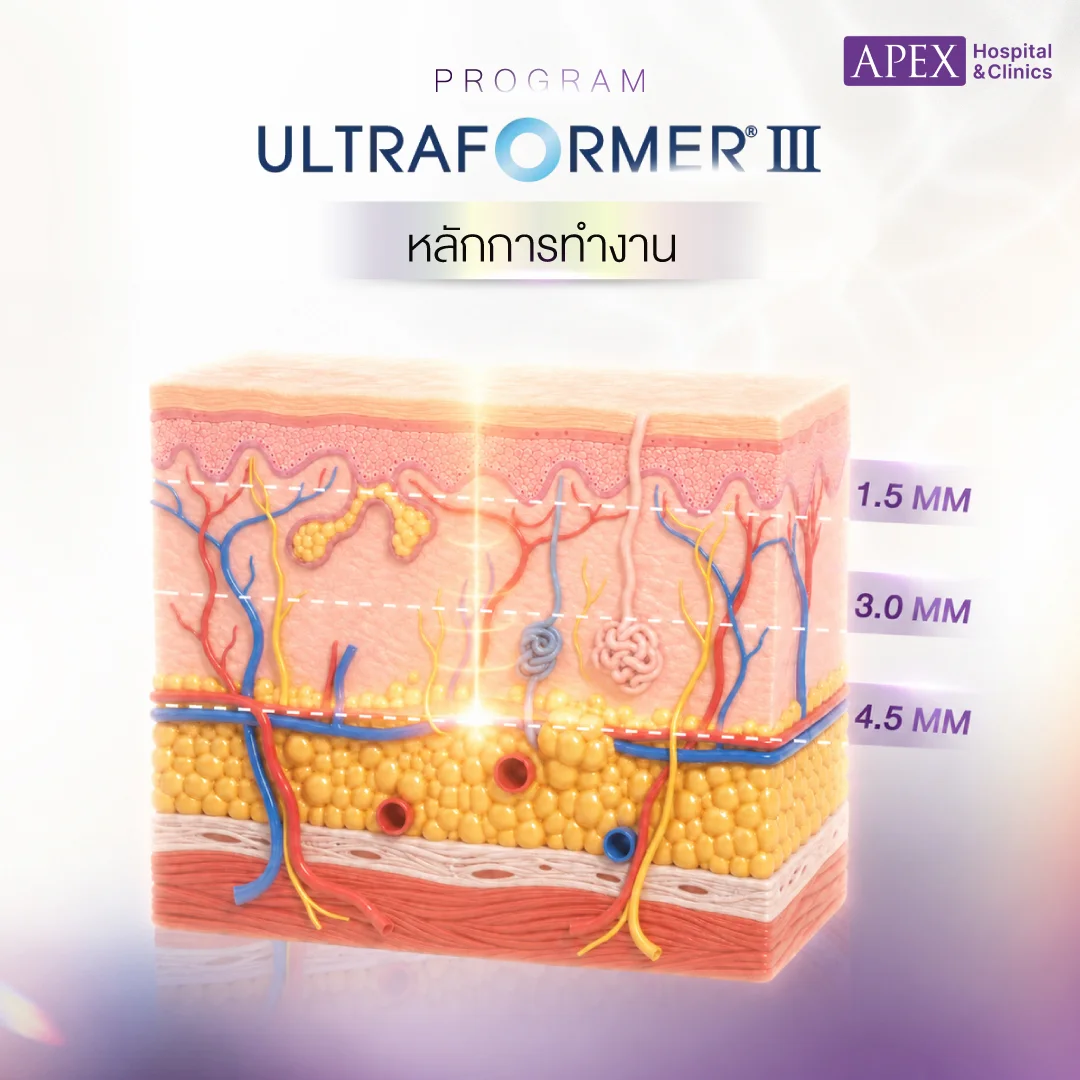 Ultraformer III มีหลักการทำงานอย่างไร