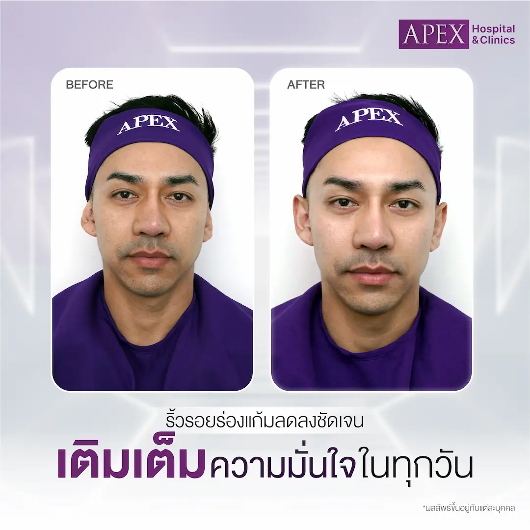 รีวิว Ultraformer MPT