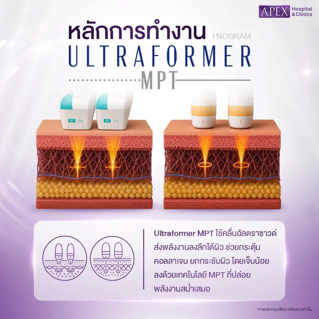 Ultraformer MPT ทำงานอย่างไร