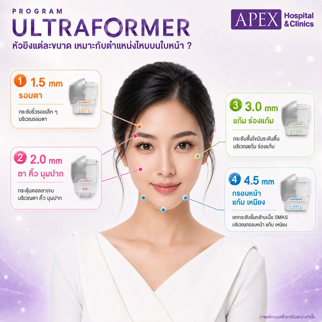 Ultraformer หัวยิงแต่ละระดับต่างกันอย่างไร