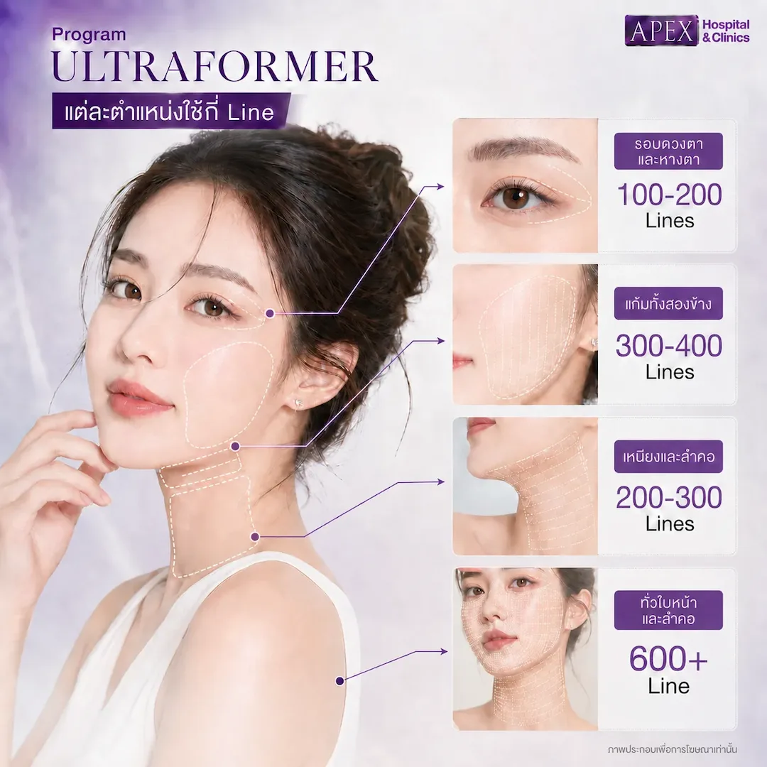 Ultraformer แต่ละตำแหน่งใช้กี่ไลน์