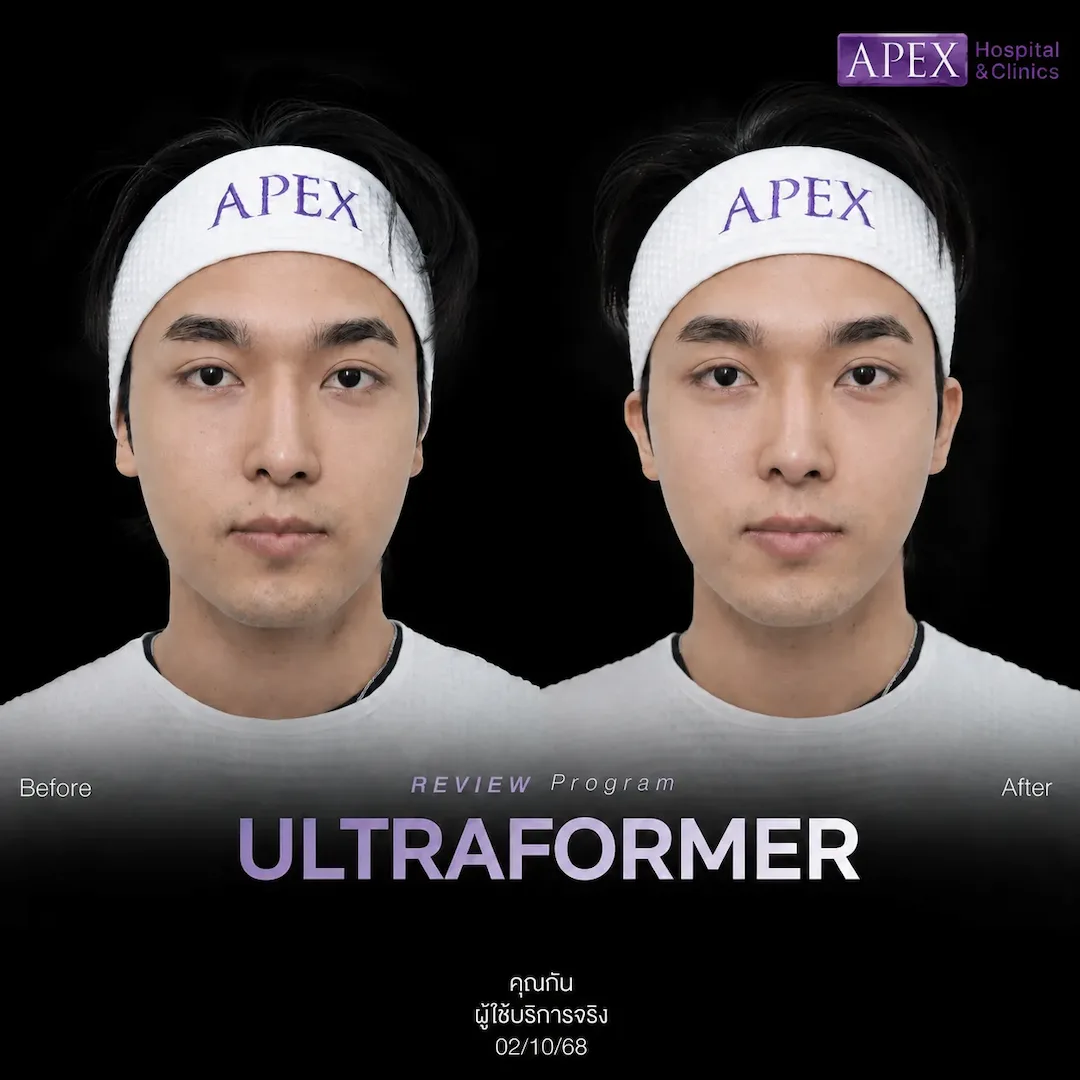 รีวิว Ultraformer