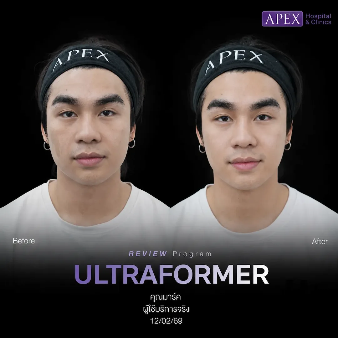 รีวิว Ultraformer
