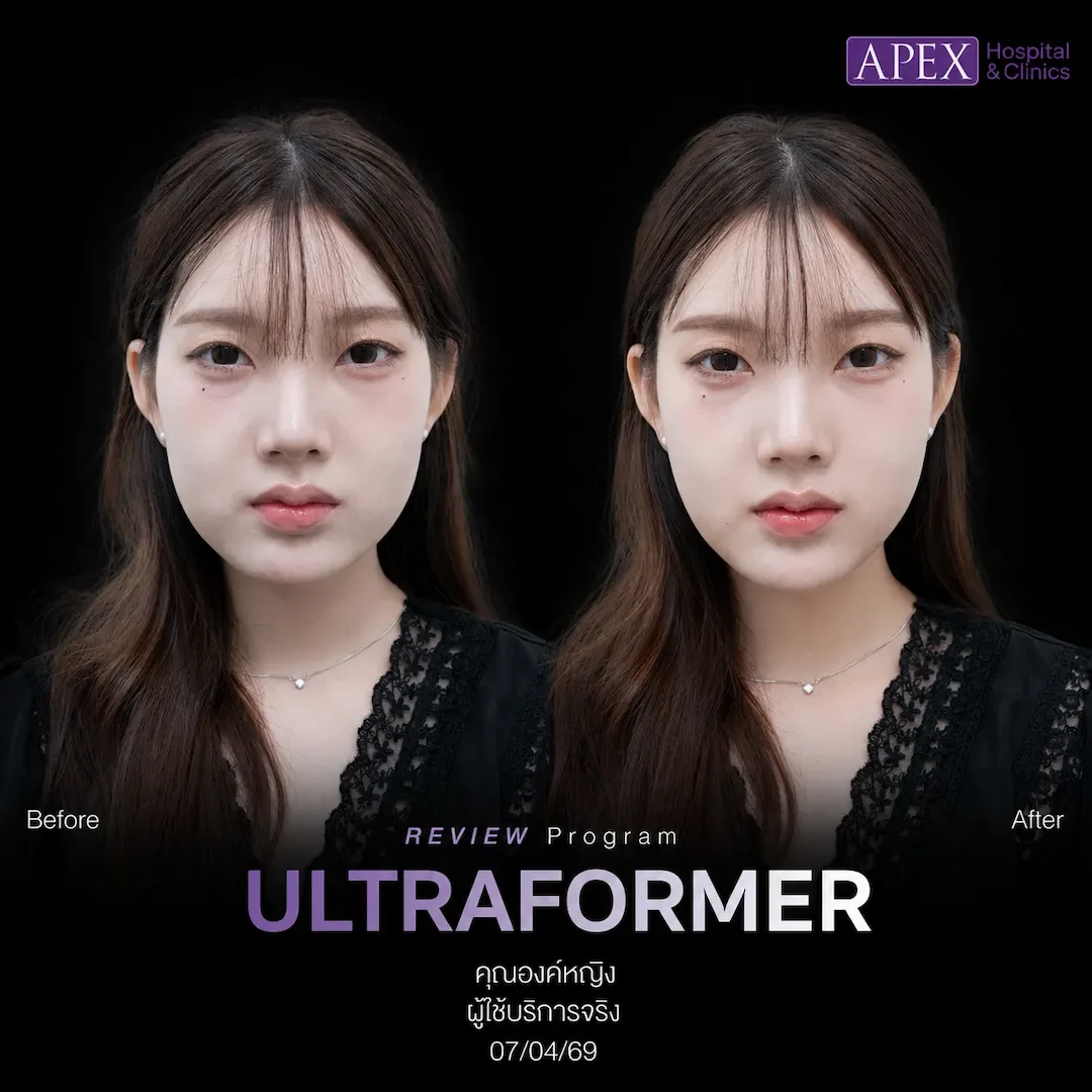 รีวิว Ultraformer