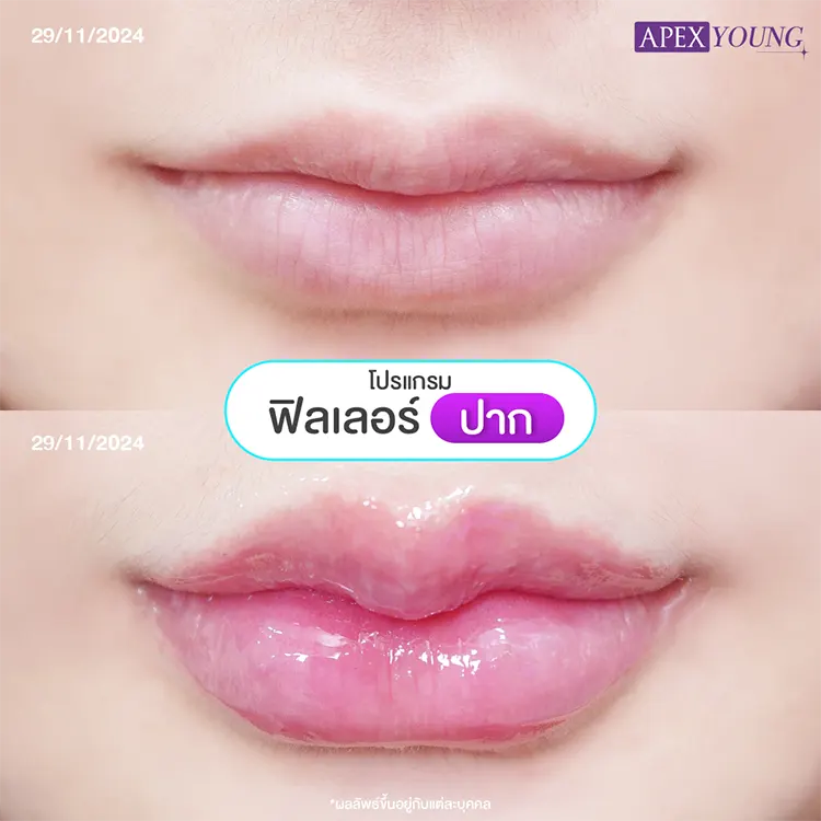 ก่อนและหลังฉีดปากกระจับ