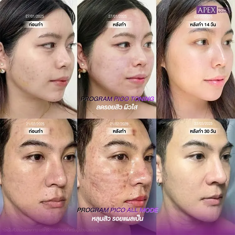 ก่อนและหลังทำ Pico Laser