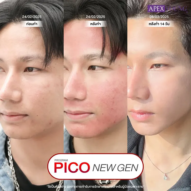 ก่อนและหลังทำ Pico Laser