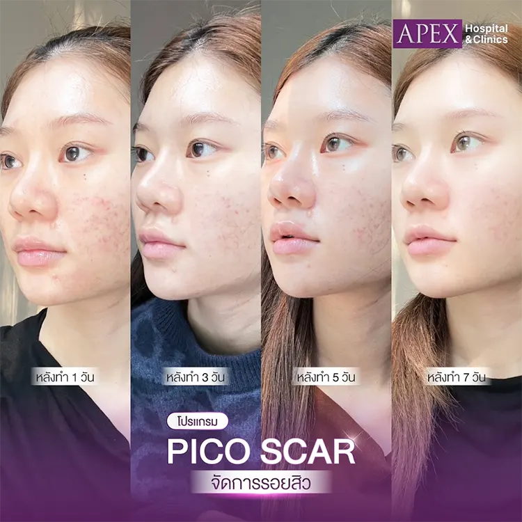 ก่อนและหลังทำ Pico Laser