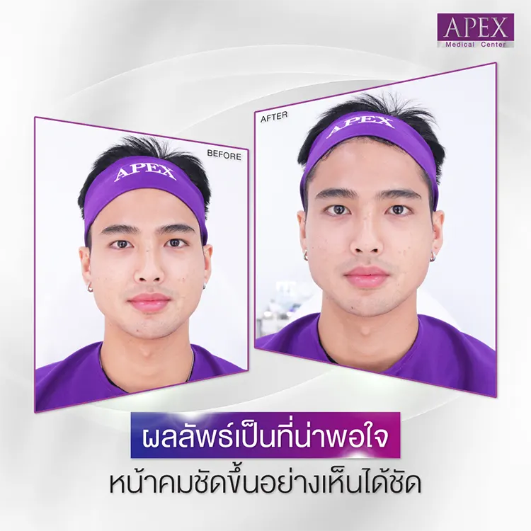 ก่อนและหลังฟิลเลอร์กรอบหน้า
