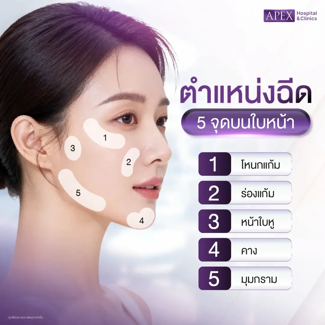 ฉีด Profhilo บริเวณไหนได้บ้าง