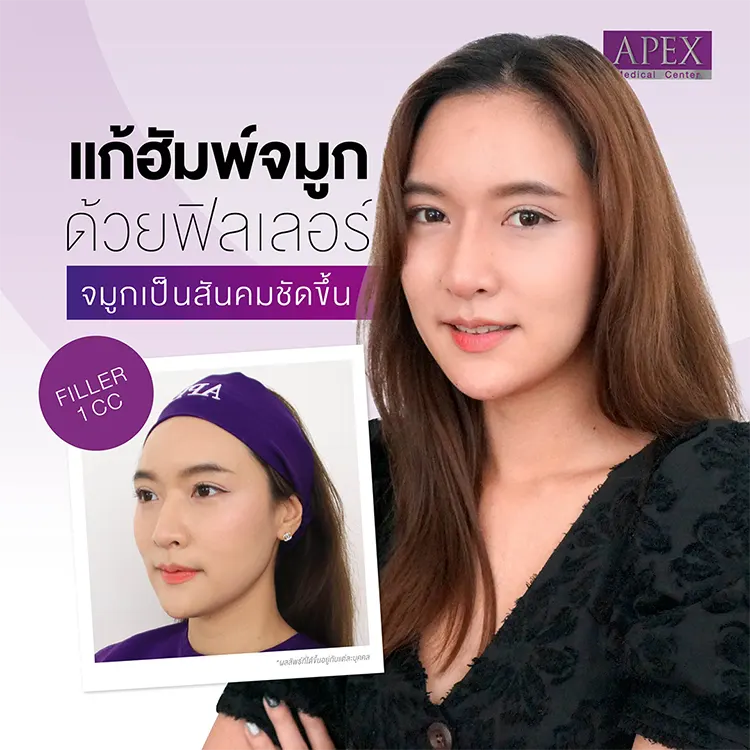 ฉีดฟิลเลอร์จมูก แก้ฮัมพ์