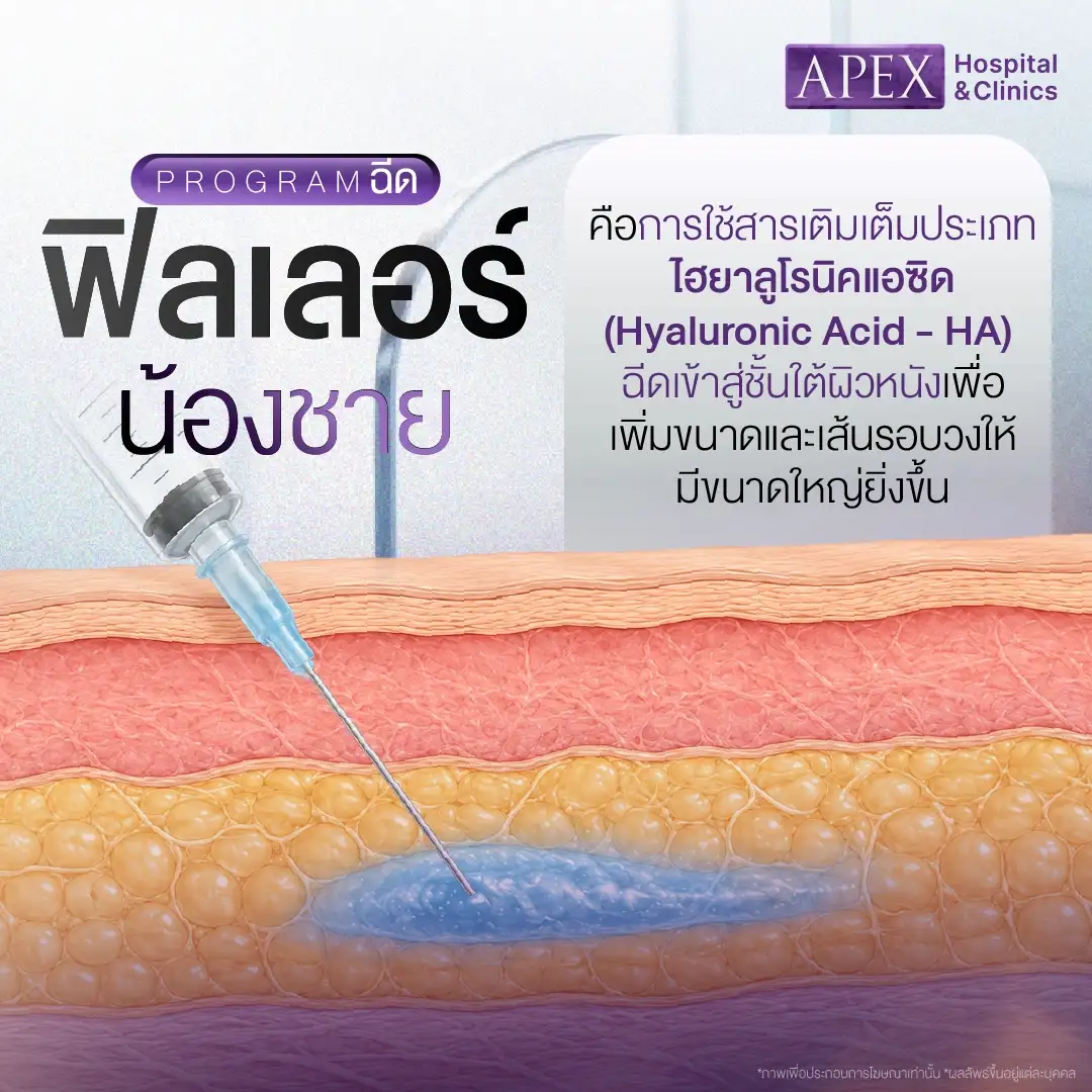 ฉีดฟิลเลอร์น้องชาย คืออะไร