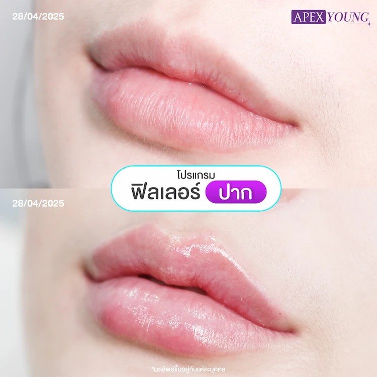 ฉีดปากกี่ cc