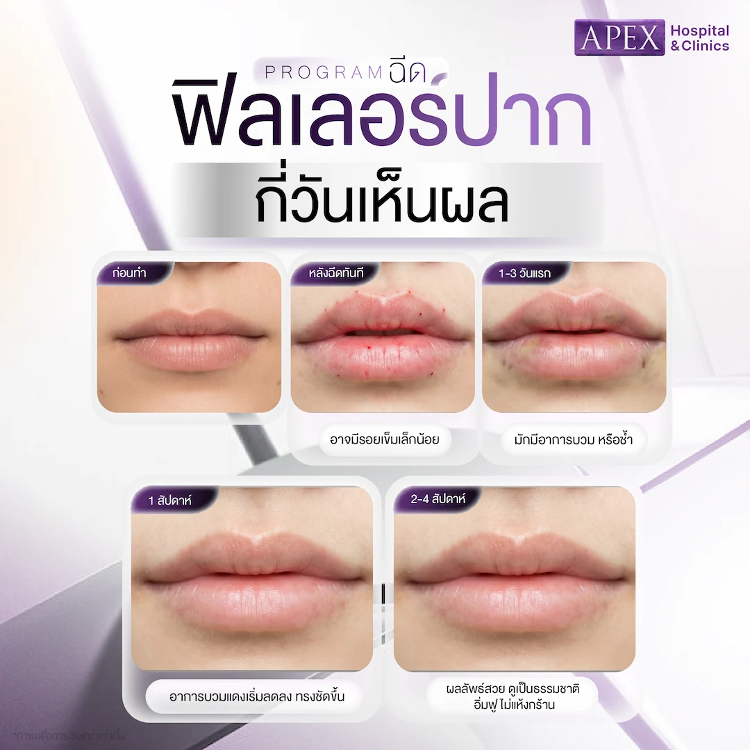 ฉีดฟิลเลอร์ปาก กี่วันเห็นผล